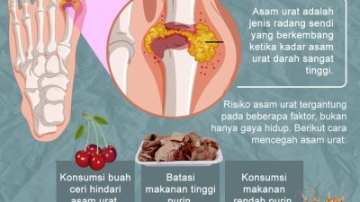 Cara Mengatasi Asam Urat Secara Alami: Panduan Lengkap untuk Kesehatan Optimal